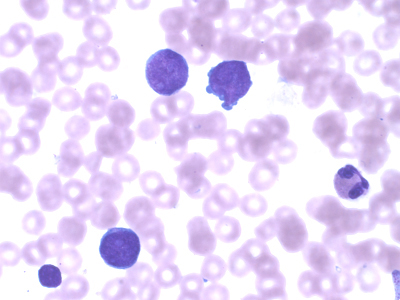 Image of megakaryoblastic cells from a patient with Down syndrome acute megakaryoblastic leukemia.