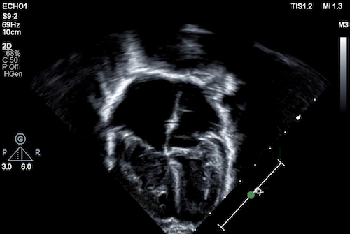 echocardiogram
