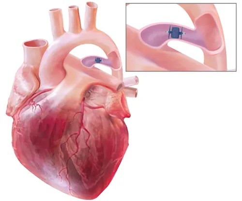 A heart with an enlarged view of medical device inside an artery