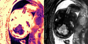 two slides of fetal brain imaging