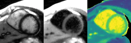 Three slides of myocardial tissue