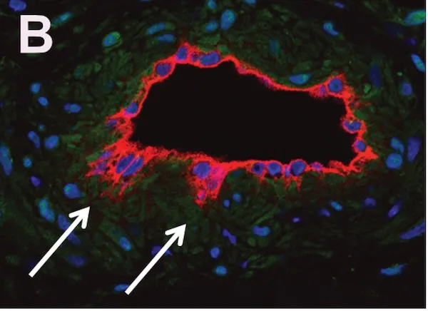A capillary malformation specimen stained with an endothelial cell marker (red) and a nuclear marker (blue); arrows point to endothelial cells that appear to be sprouting from the vessel, suggesting angiogenic activation. 