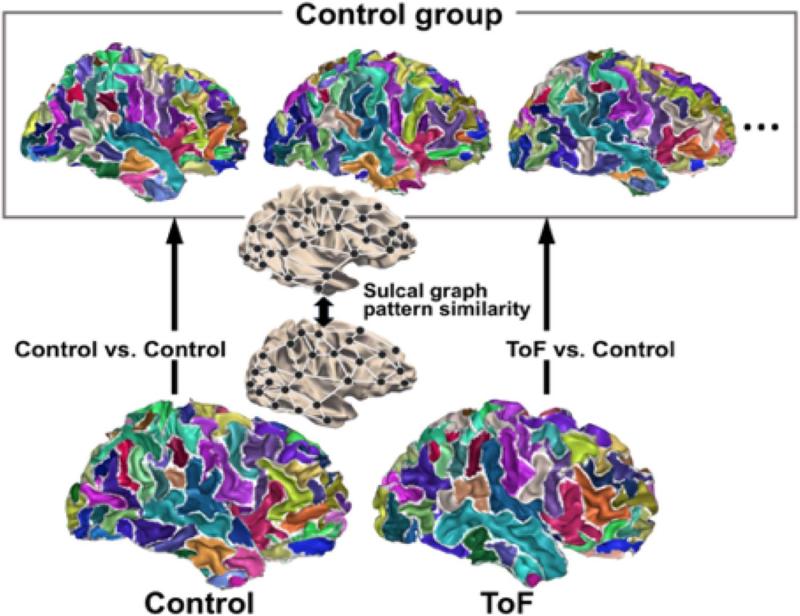 CHD-Neurodevelopment