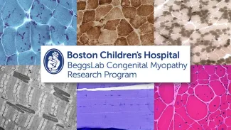 Illustration: Boston Children's Hospital Beggs Lab Congenital Myopathy Research Program