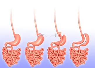 Four panels of the small intestine that show weight loss with bariatric surgery.